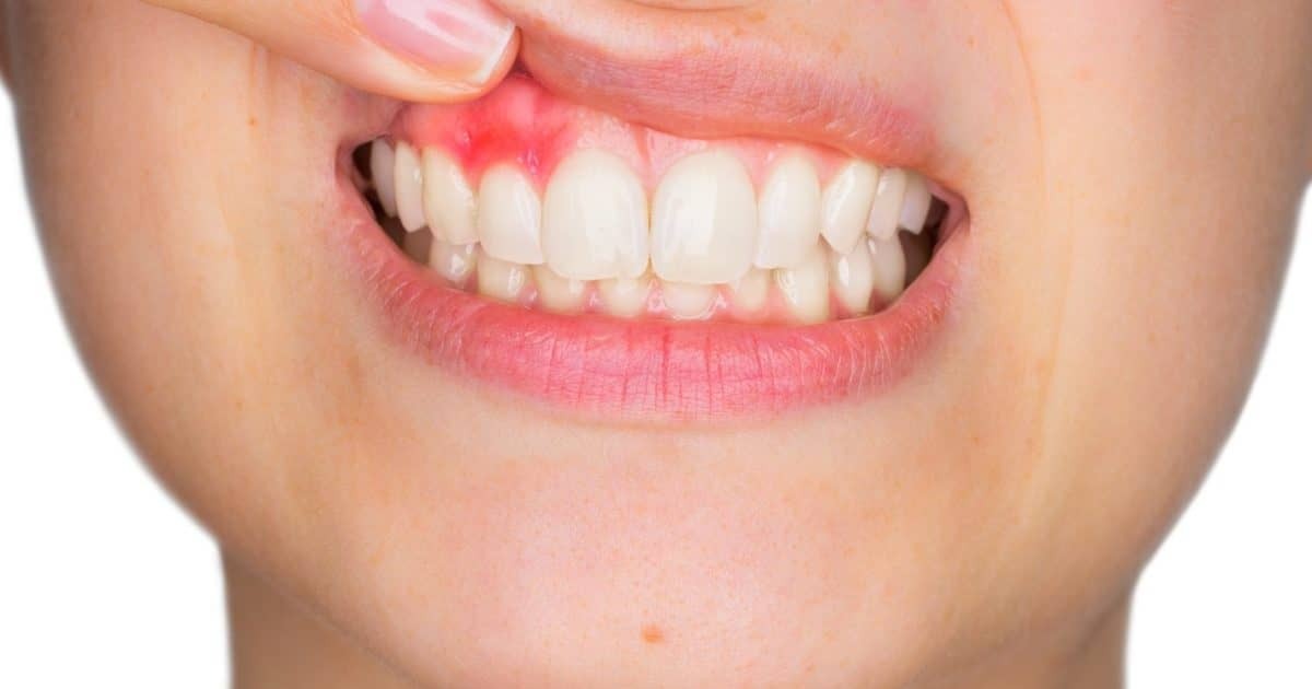 Gum Swelling After Tooth Extraction