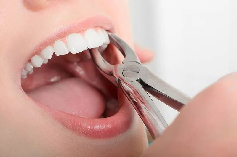 Tooth Extraction in Cudahy
