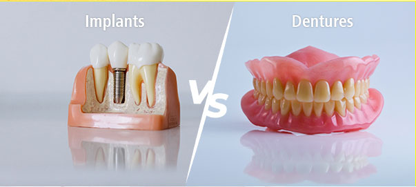 Dental Implants vs. Dentures