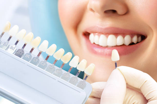 Teeth Whitening in Riyadh