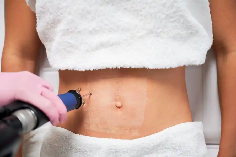 Laser Treatment for Stretch Marks
